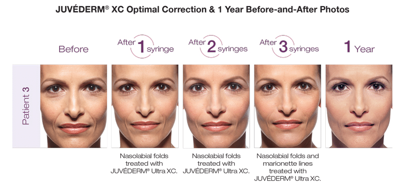 Juvederm West Orange NJ