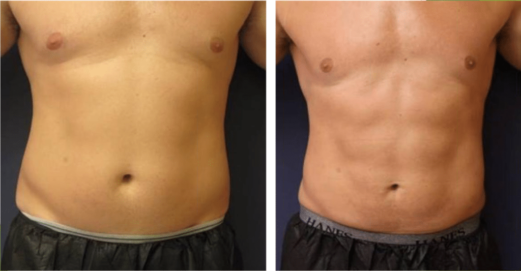 Emsculpt Before and After New Jersey