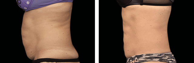 Emsculpt Before and After New Jersey