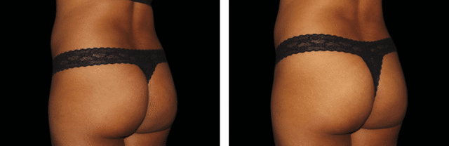 Emsculpt Before and After New Jersey