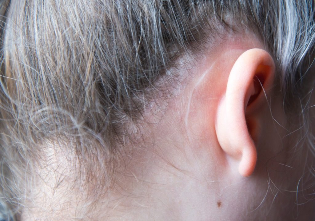 Scar behind the ear after having otoplasty surgery