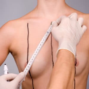 Breast Augmentation Surgery | Breast Implants | Citron & Citron